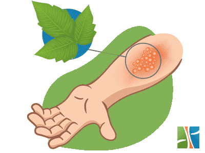 How to heal poison ivy rash